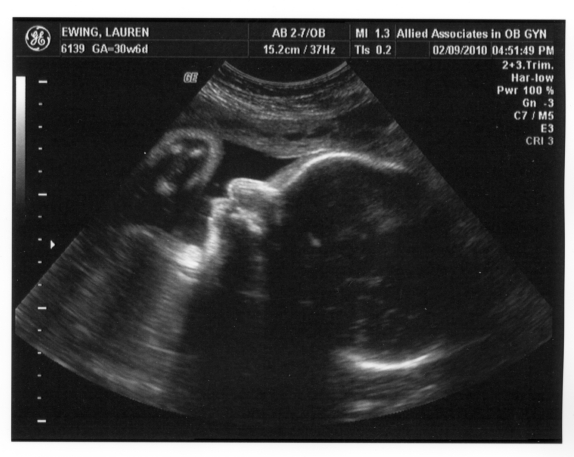 Baby Brother 9Feb10 at Minus 8 wks